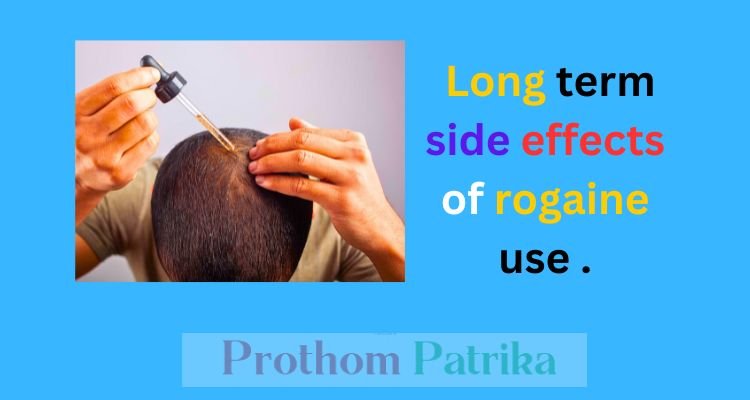 Long term side effects of rogaine use 